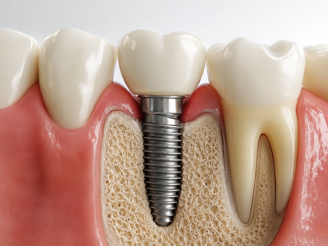Modelo de implante dentário sobre o osso